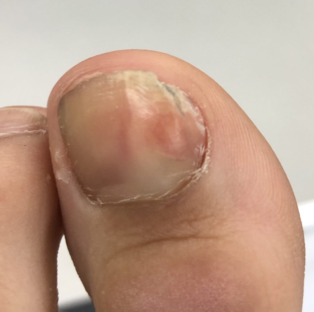 dystrophic toenail